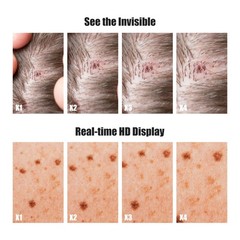 Handheld Dermatoscope, 500X Magnification Skin & Scalp Analyzer for Scalp/Hair
