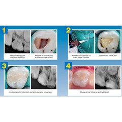 Dental THERACAL PT DC Resin Modified Calcium Silicate Material 4gm Syr & 15 Tips