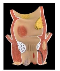 Anatomical Human Rectum Pathology Lesion Model Hemorrhoids Anus Teaching Supply