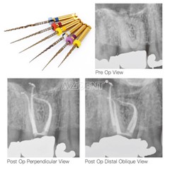 6Pcs Dental Endodontic Endo NITI Rotary Files X-Pro Gold Taper Tip Assorted 25mm
