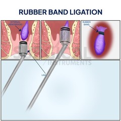 Hemorrhoid Suction Ligator Down Angle With 100 Latex Bands Surgical Instruments