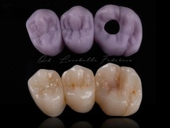 CEREC® Blocks Lithium Disilicate x5