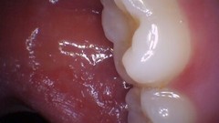 PerfectCam HD Intraoral Camera, USB Dental Camera, Free Capture Button Software.