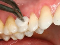 Denpro Cavity Varnish with Flouride 15gm For Dental Use (FREE & FAST SHIPPING).