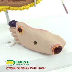 Medical Anatomical Human Diabetes Model 8 Parts Shows The Harm Of Diabetes