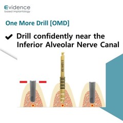 Evidence Implant One More Drill [OMD]