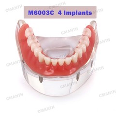 US Dental Model Removable Overdenture Teeth Upper/Lower Jaw 4 Implants Model