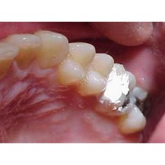 DSI Zoer Dental Cement IRM Zinc Oxide Eugenol Temporary Filling Material