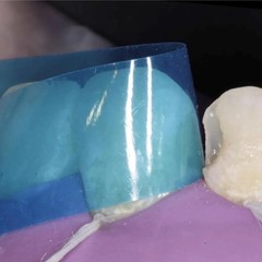 Dental Contoured Anterior Matrix Bands Teeth Restoration Strip Twin Matrices