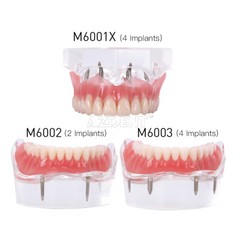 Modelo Demostración Implantes Dentales Sobredentadura Rehabilitada Sup/Inf 2 y 4