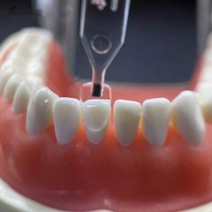 30pcs Dental Composite Resin Veneers Mould Light Cure Anterior Front Teeth USA