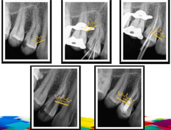Dental X3 Endo Rotary File Root Canal Curval File Endodontic NITI file21/25/31mm