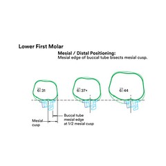 J&J Ortho™ Orthodontic #6 First Molar Band Quadrant (4/pk) Optional Size