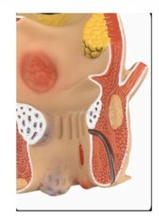 Anatomical Human Rectum Pathology Lesion Model Hemorrhoids Anus Teaching Supply