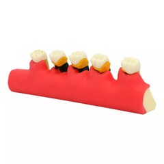 Dental Pathological Typodont Teeth Model Periodontics/Implant/Endodontic Caries