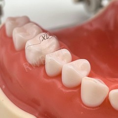 Dental Matrix Bands Ring Sectional Matrix Clamp Clear Matrix Anterior Matrices