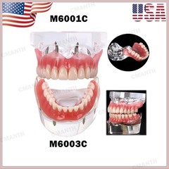 US Dental Model Upper Lower Jaw 4 Overdenture Practice Implant Typodont Demo