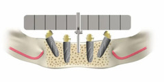 original julldent All on 4 Guide for multiple placement of implant FREE SHIPPING