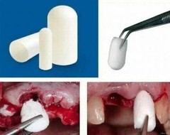 10 Pack of Colo Plug – Resorbable Collagen Plug 8x20mm. FRESH STOCK TARIFF PAID