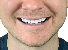Instant Smile Flex 2Pk – Bright White Shade – One Size Fits Most. Fix Your