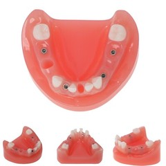Dental Implant Model Upper Lower Jaw Demo All on 4/6 Overdenture treatment model
