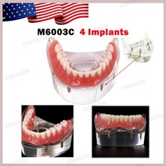 US Dental Model Removable Overdenture Teeth Upper/Lower Jaw 4 Implants Model