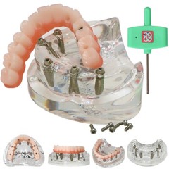 Dental Implant Model Upper Lower Jaw Demo All on 4/6 Overdenture treatment model