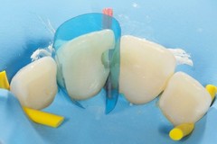 Dental Blue Strip Anterior Matrix Strips IV Composite Matrices Bands