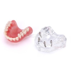 Modelo Demostración Implantes Dentales Sobredentadura Rehabilitada Sup/Inf 2 y 4