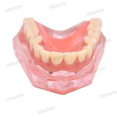 Dental Overdenture Implant Teeth Model Denture with implant Demonstration Pink
