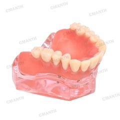 Dental Overdenture Implant Teeth Model Denture with implant Demonstration Pink