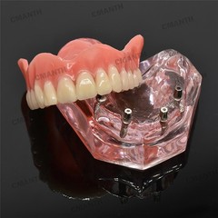 Dental Overdenture Implant Teeth Model Denture with implant Demonstration Pink