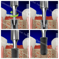 Dental Fixture Remover Screw Broken Implants Pick Up Extractor Failed SOS Screws