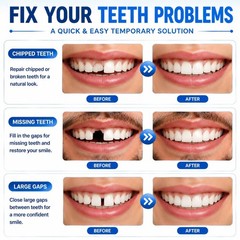 Sukh 10.9oz Moldable False Teeth Beads – Tooth Repair Kit,Repair Small, White