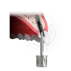 US Dental Angled Implant Screwdriver Angulated Screw Channel Driver ASC 1.27 Mis