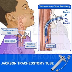 Jackson Trachea Tubes 00-12 Surgical Instruments Available In Individual & Set