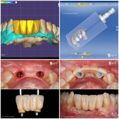CEREC® Blocks Lithium Disilicate x5