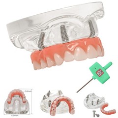Dental Implant Model Upper Lower Jaw Demo All on 4/6 Overdenture treatment model