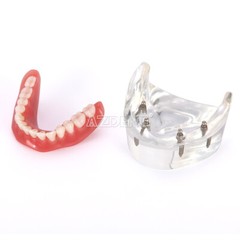 Modelo Demostración Implantes Dentales Sobredentadura Rehabilitada Sup/Inf 2 y 4